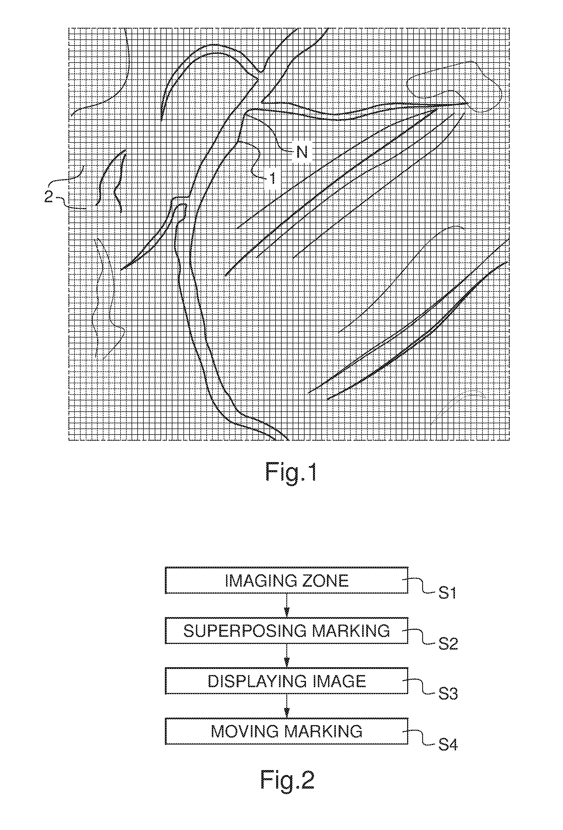 Imaging method of a zone of a patient's body superposing distance marking