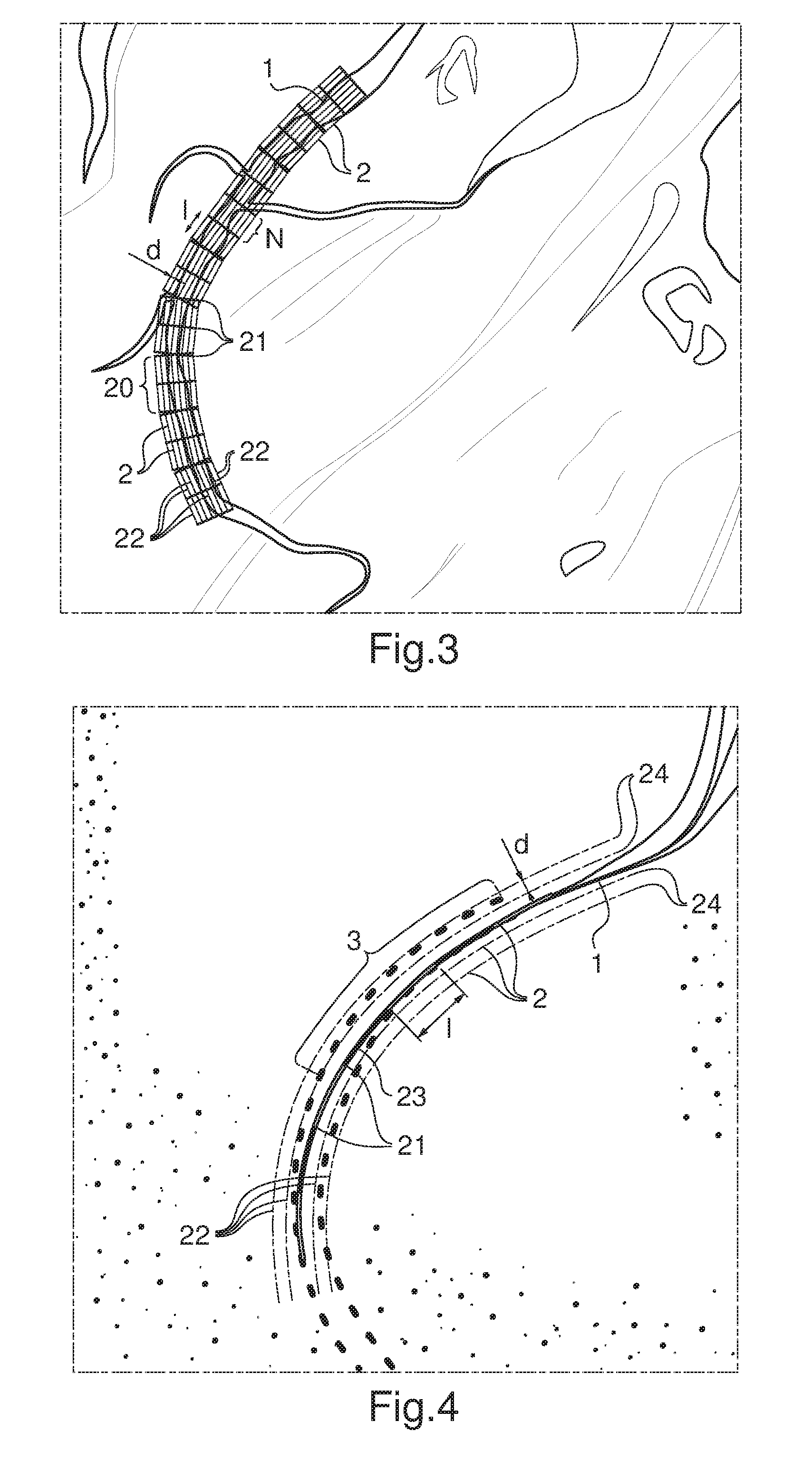 Imaging method of a zone of a patient's body superposing distance marking