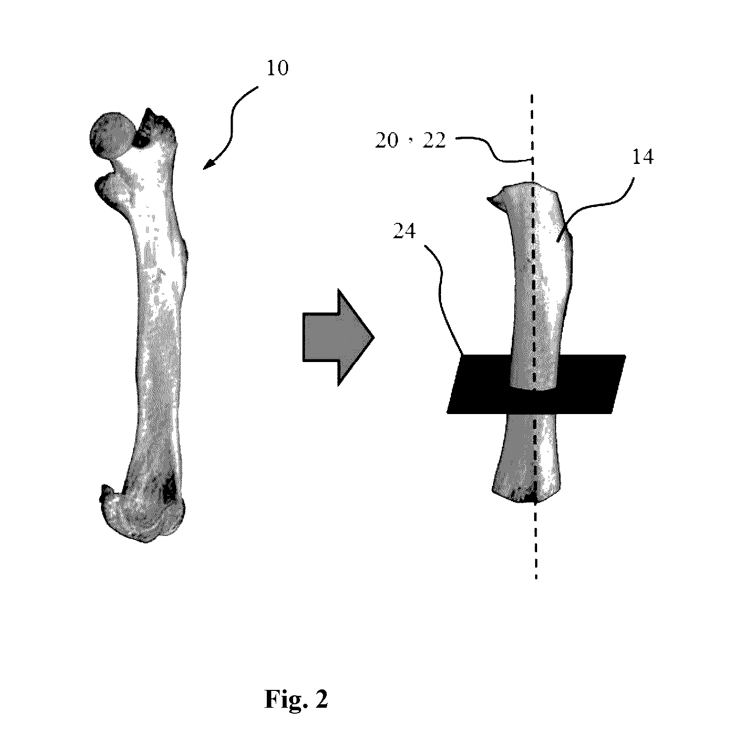 Method and system for detection of bone structure