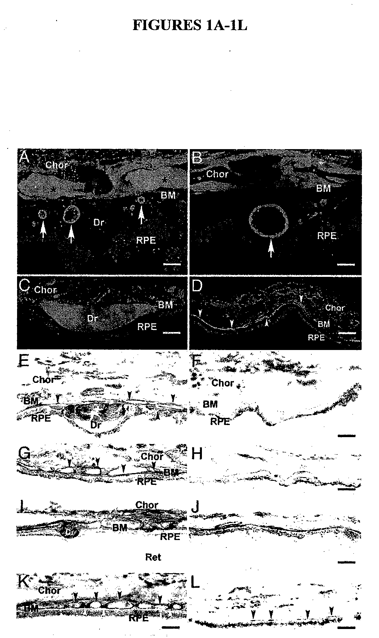 Therapeutic Compositions for Age-Related Macular Degeneration