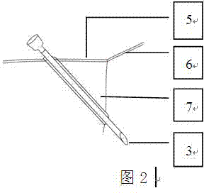 Minz deep tissue suture method and Minz deep tissue suture instrument