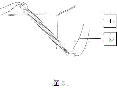 Minz deep tissue suture method and Minz deep tissue suture instrument