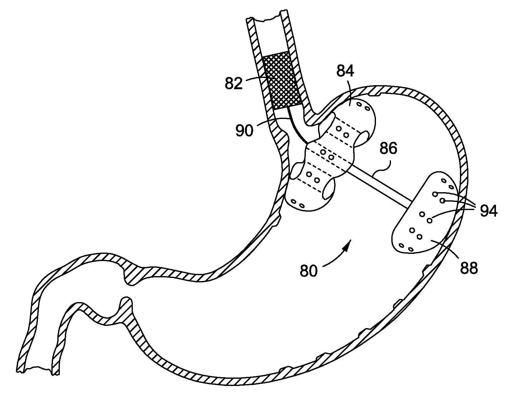 Upper stomach gastric implants