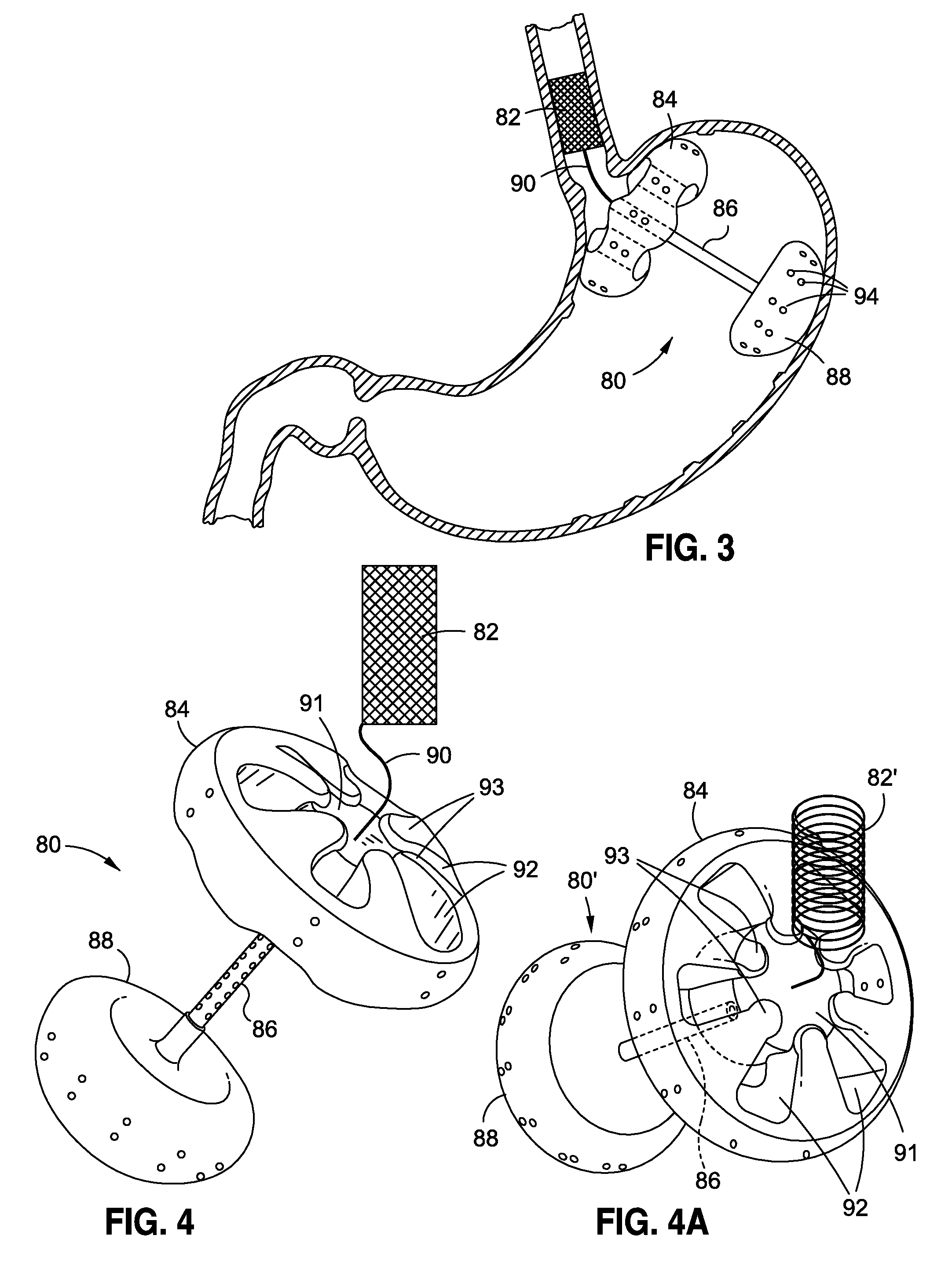 Upper stomach gastric implants