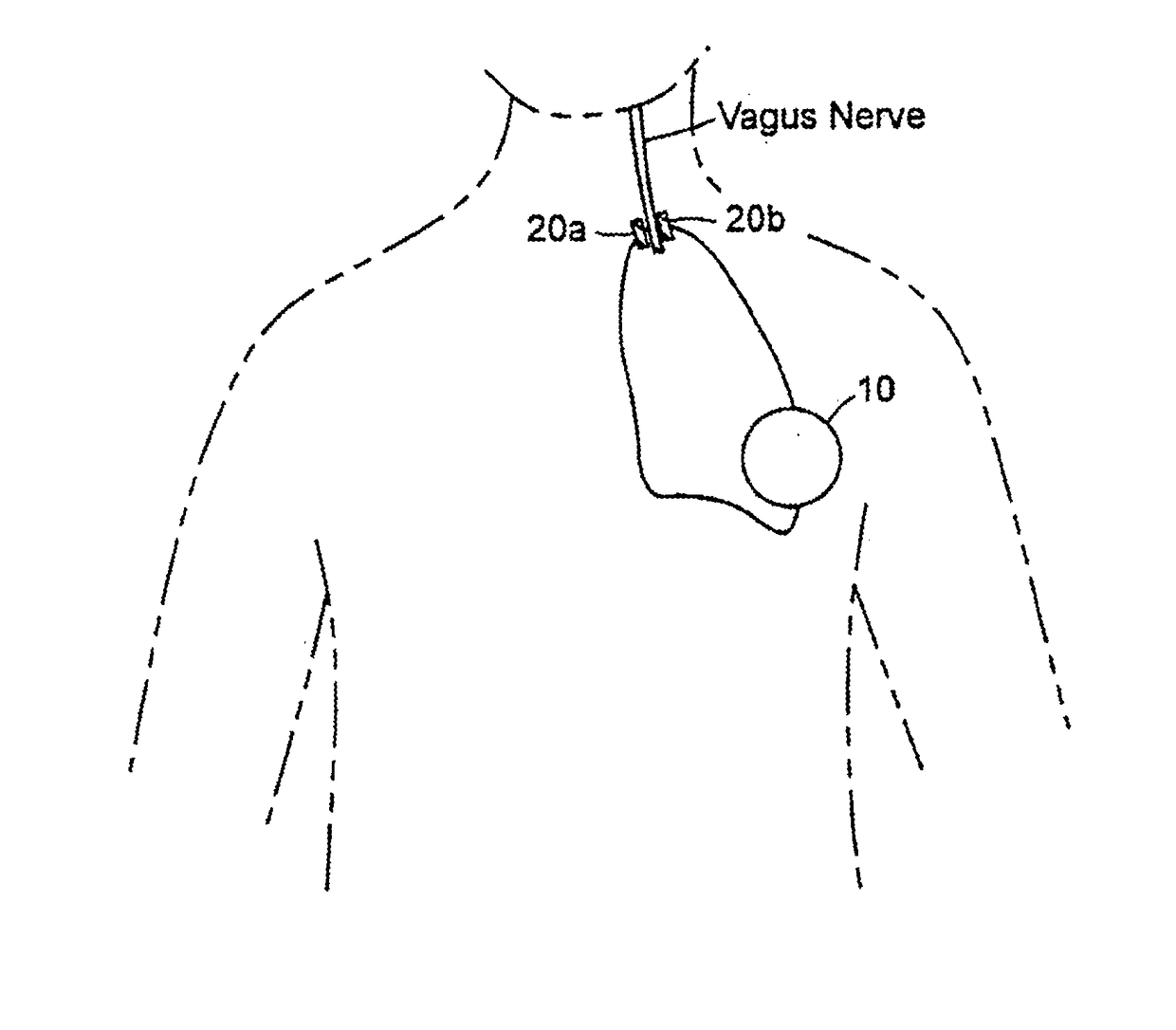 System and method for improving emotional well-being by vagal nerve stimulation