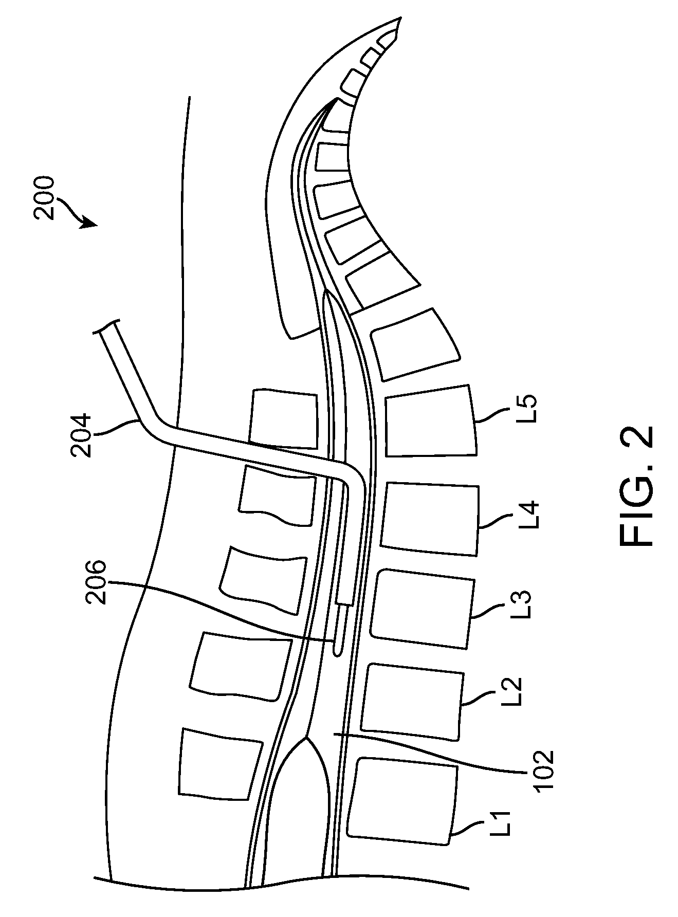 Intraventricular Shunt and Methods of Use Therefor