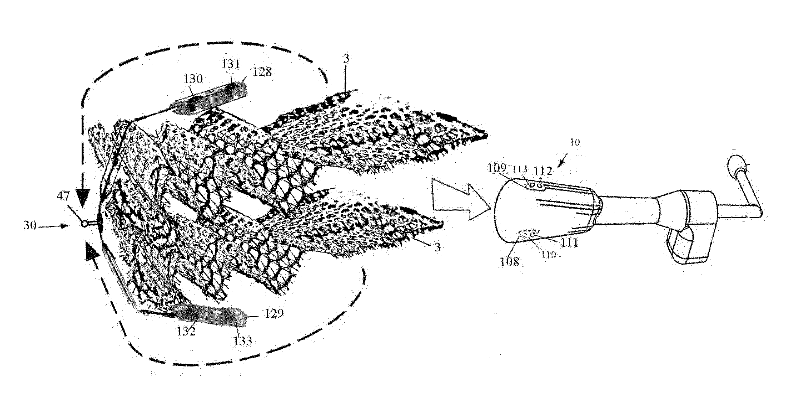 Endoscopic mesh delivery system with integral mesh stabilizer and vaginal probe