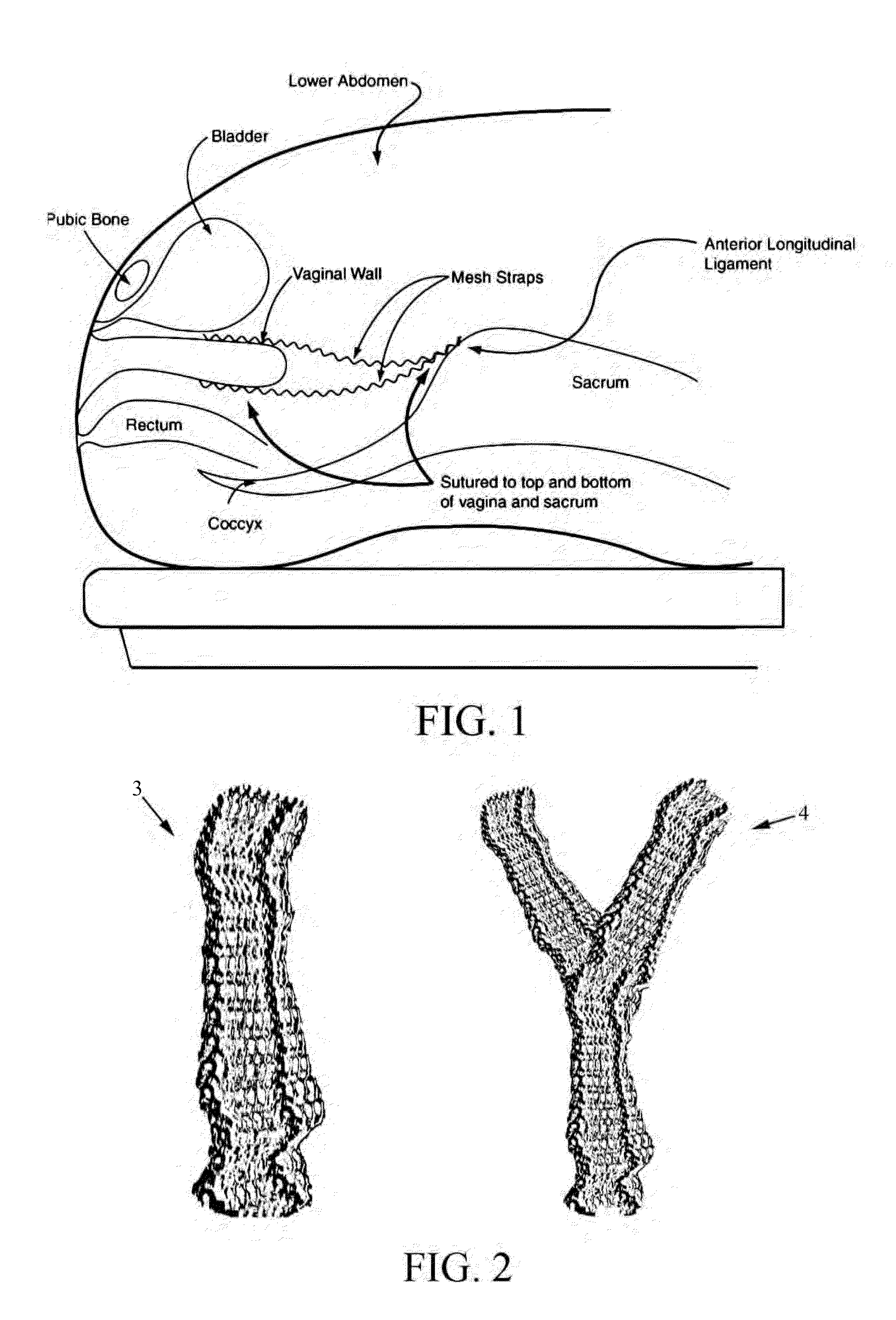 Endoscopic mesh delivery system with integral mesh stabilizer and vaginal probe