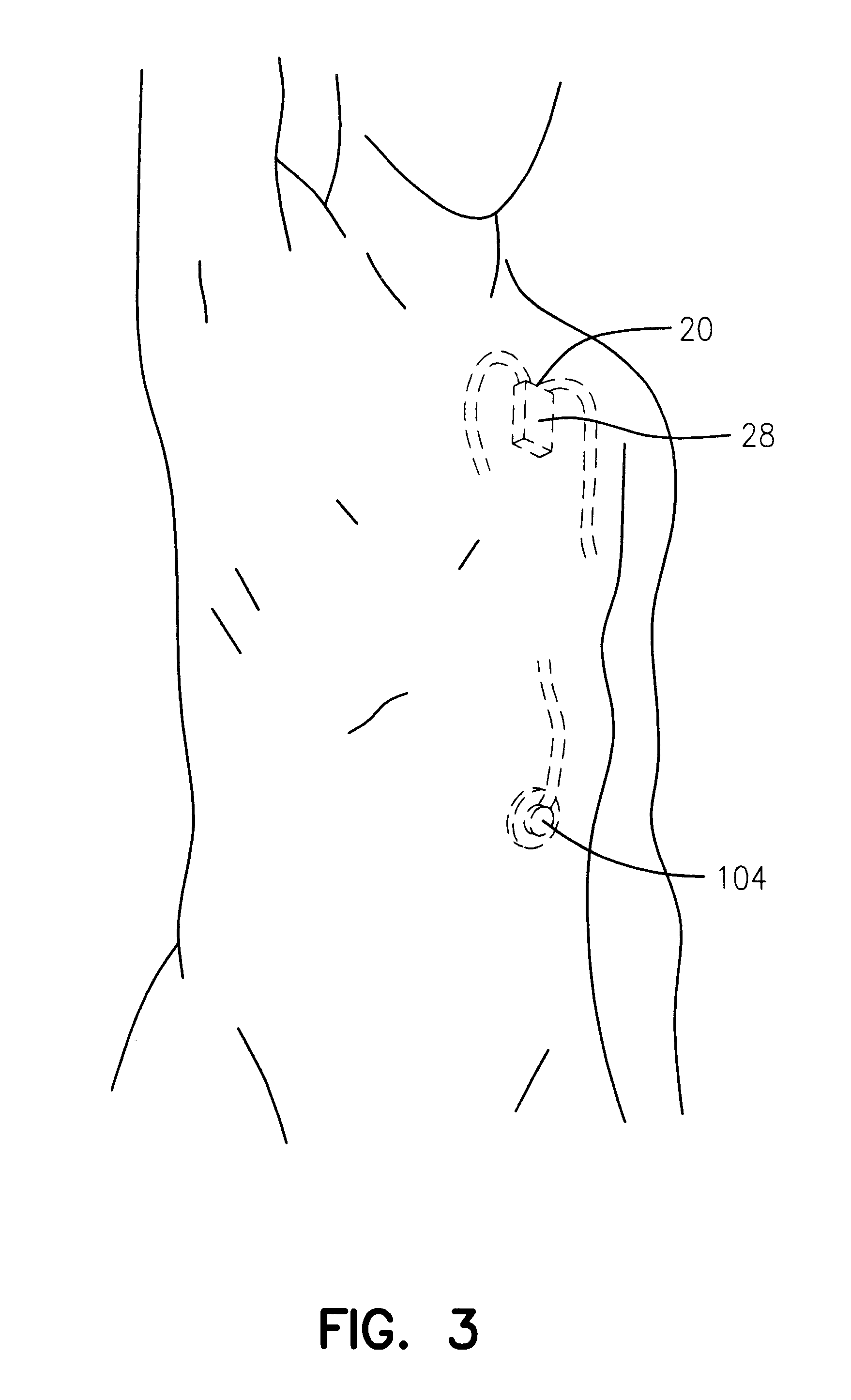 Implantable fluid delivery device for basal and bolus delivery of medicinal fluids