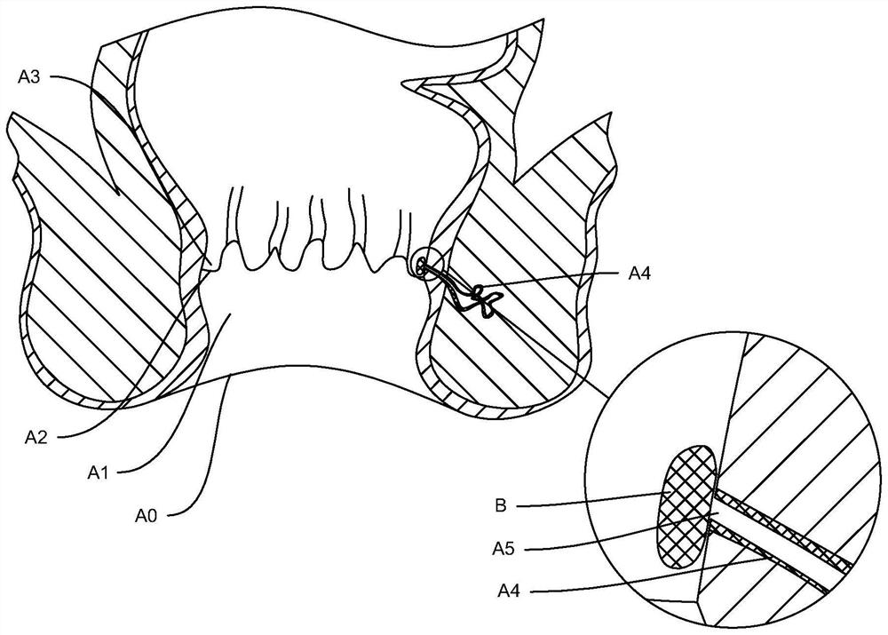 Rectal administration device