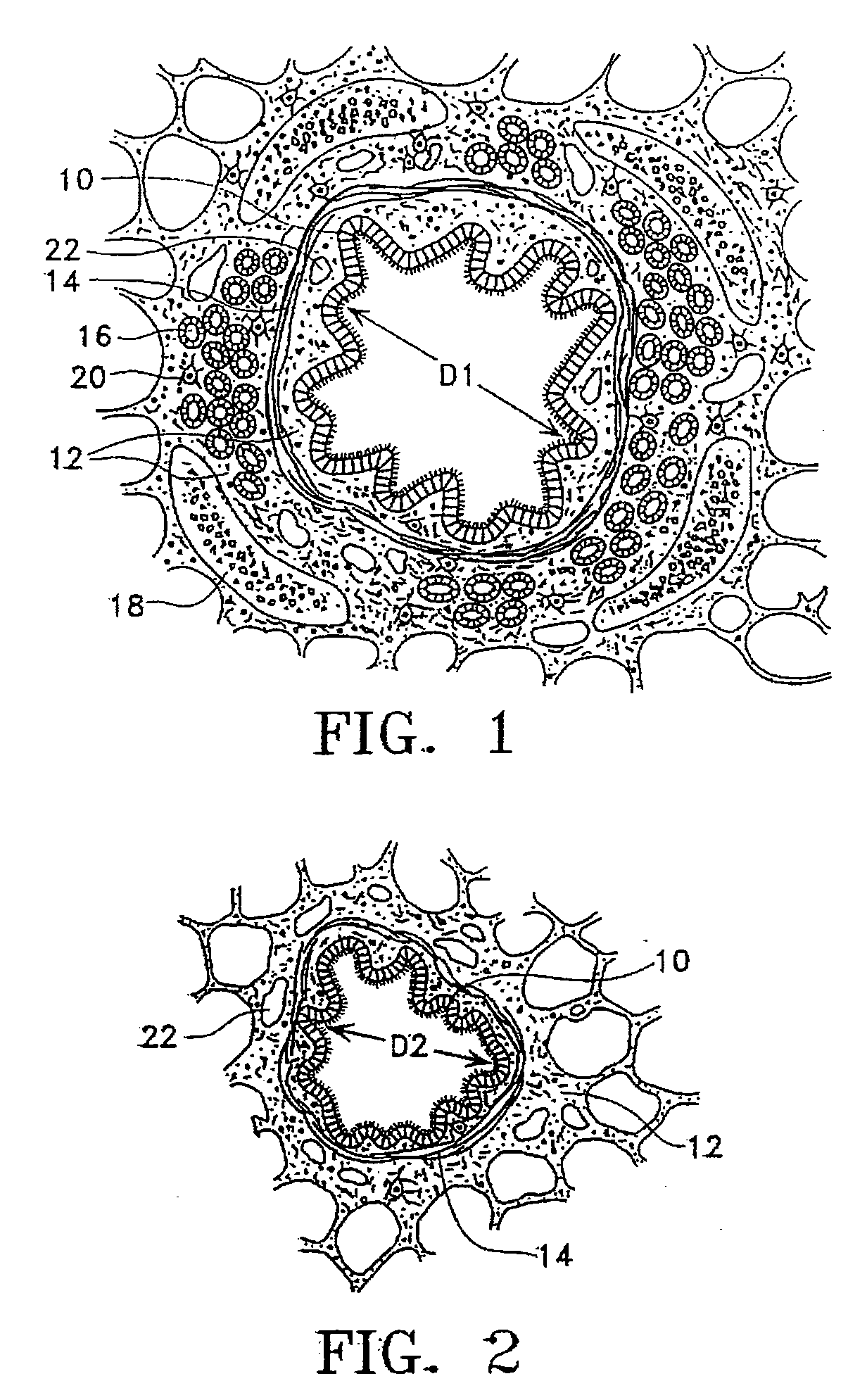 Bipolar devices for modification of airways by transfer of energy