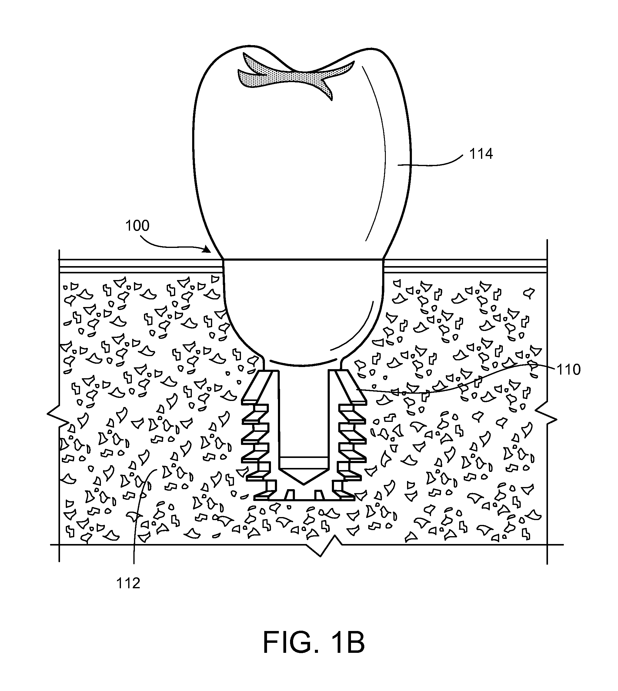 Integrated Dental Implant Abutments