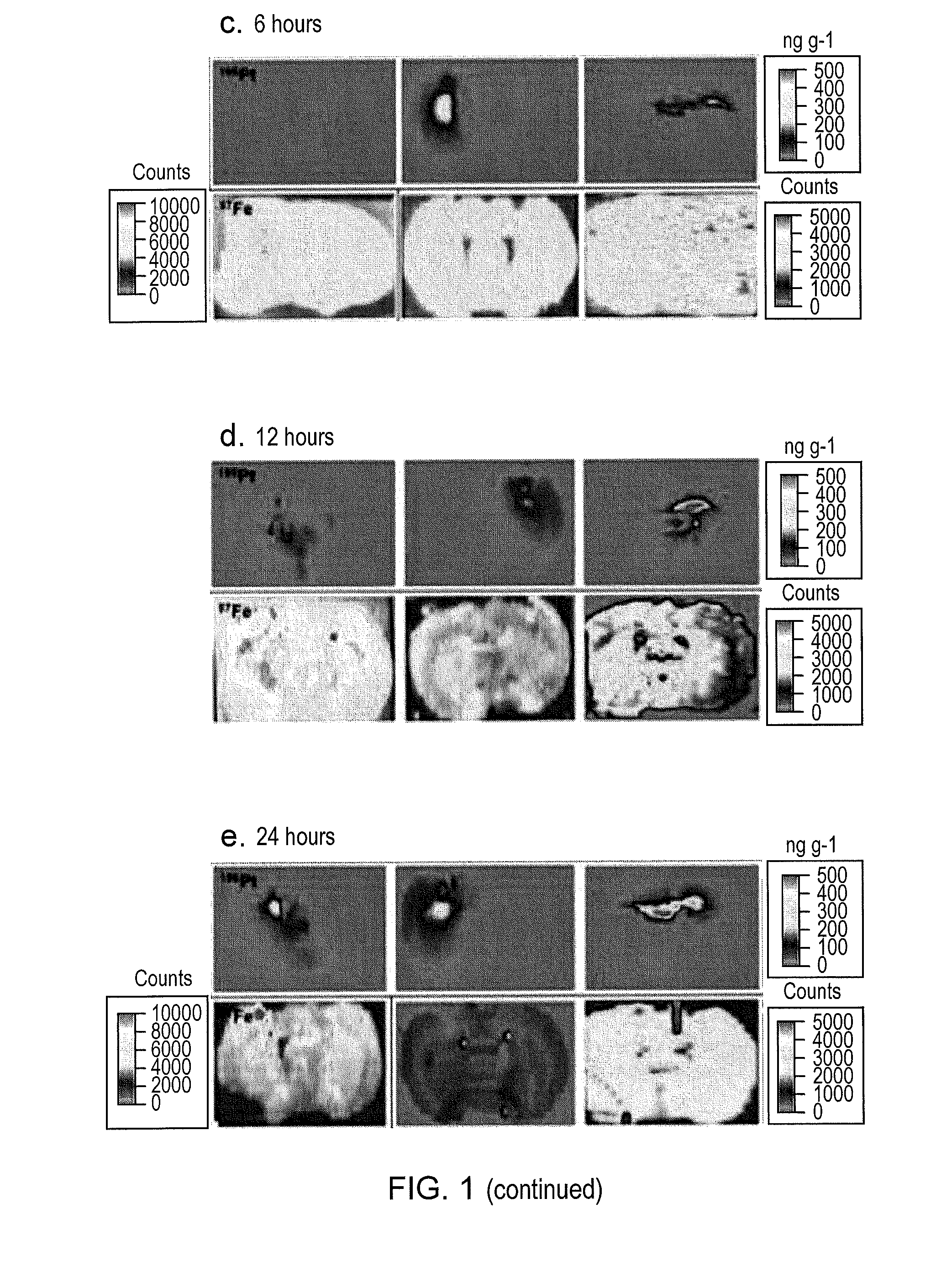 Glioma treatment