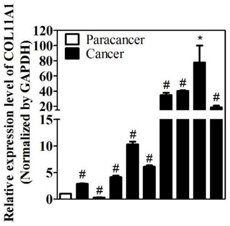 Molecular marker COL11A1 and application thereof to breast cancer drugs