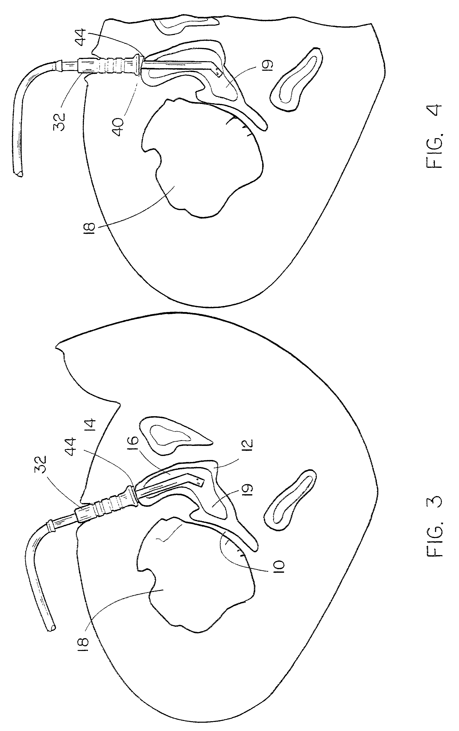 Method and means for cementing a liner onto the face of the glenoid cavity of a scapula