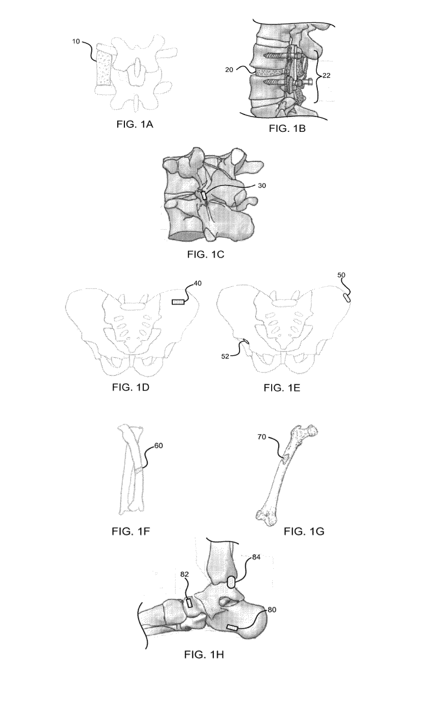 Moldable bone graft compositions