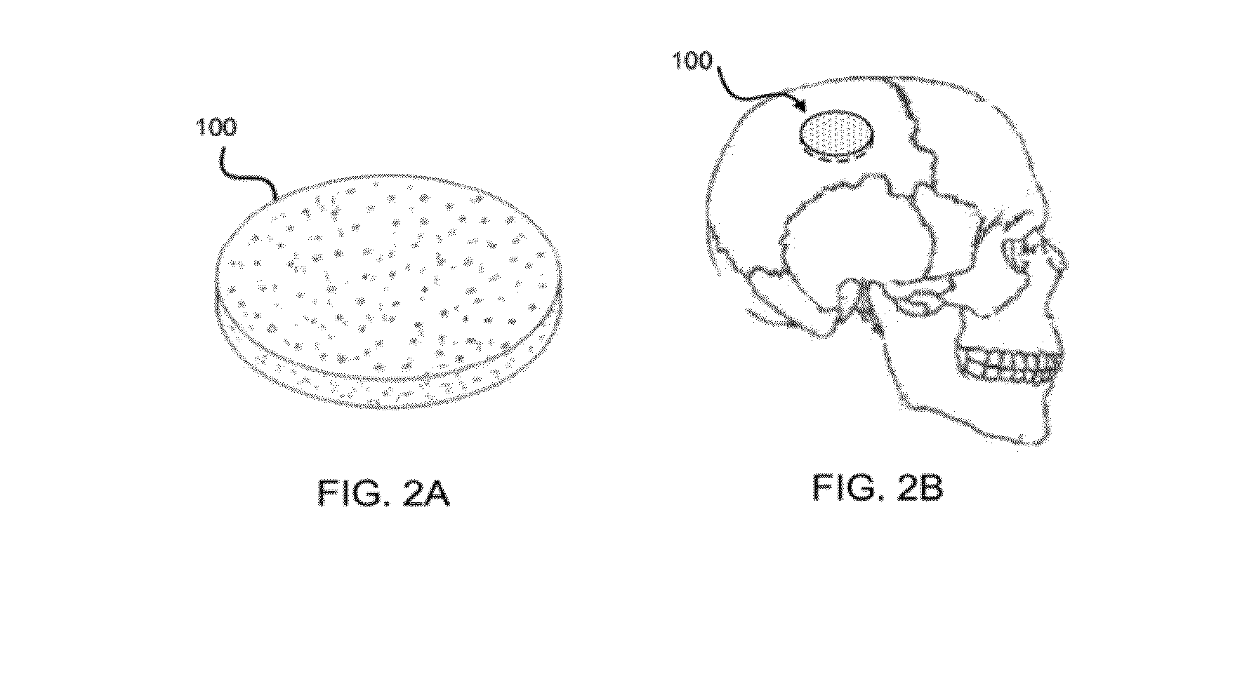 Moldable bone graft compositions