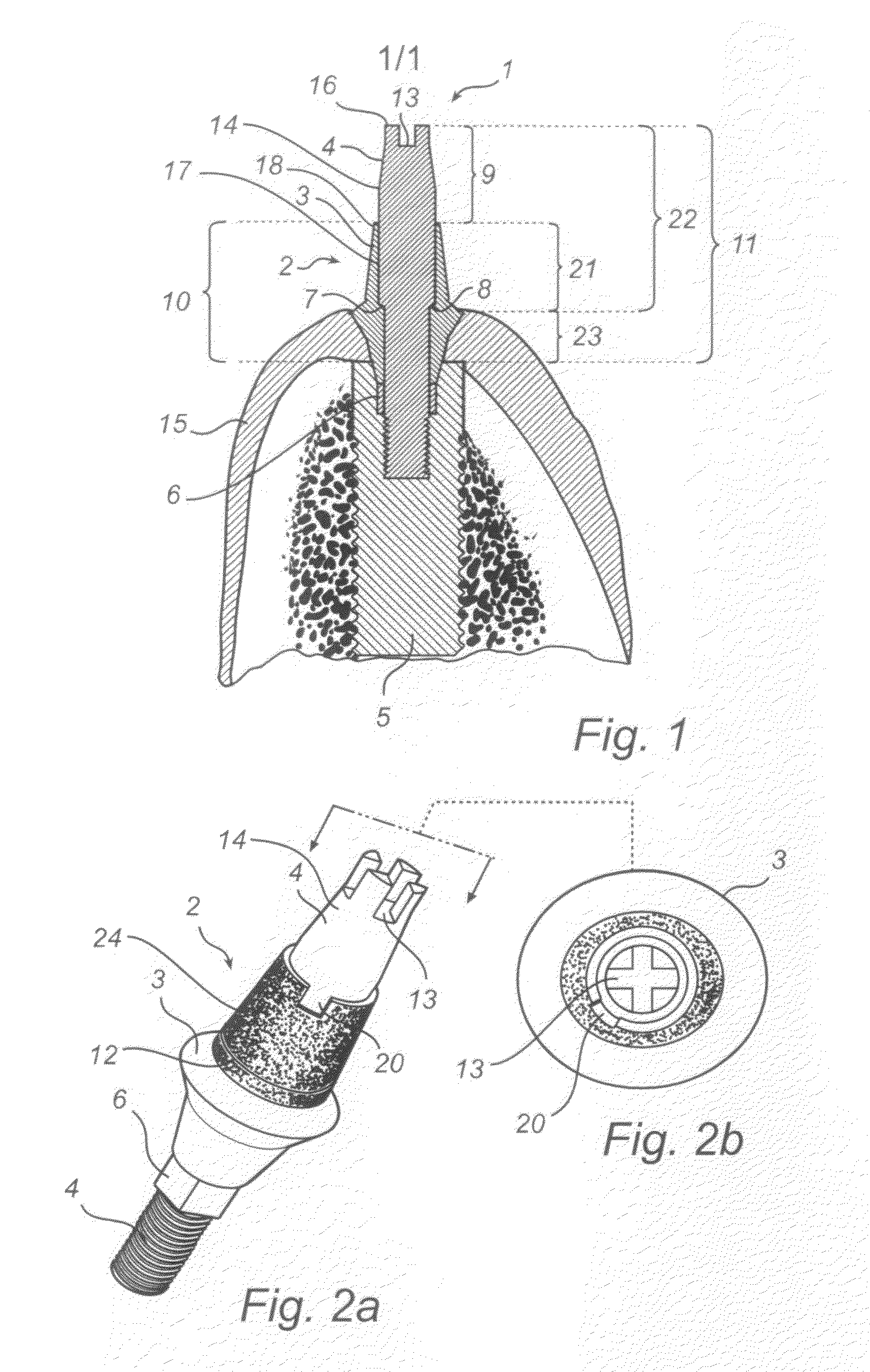 Dental implant, abutment structure and method for implanting a dental implant