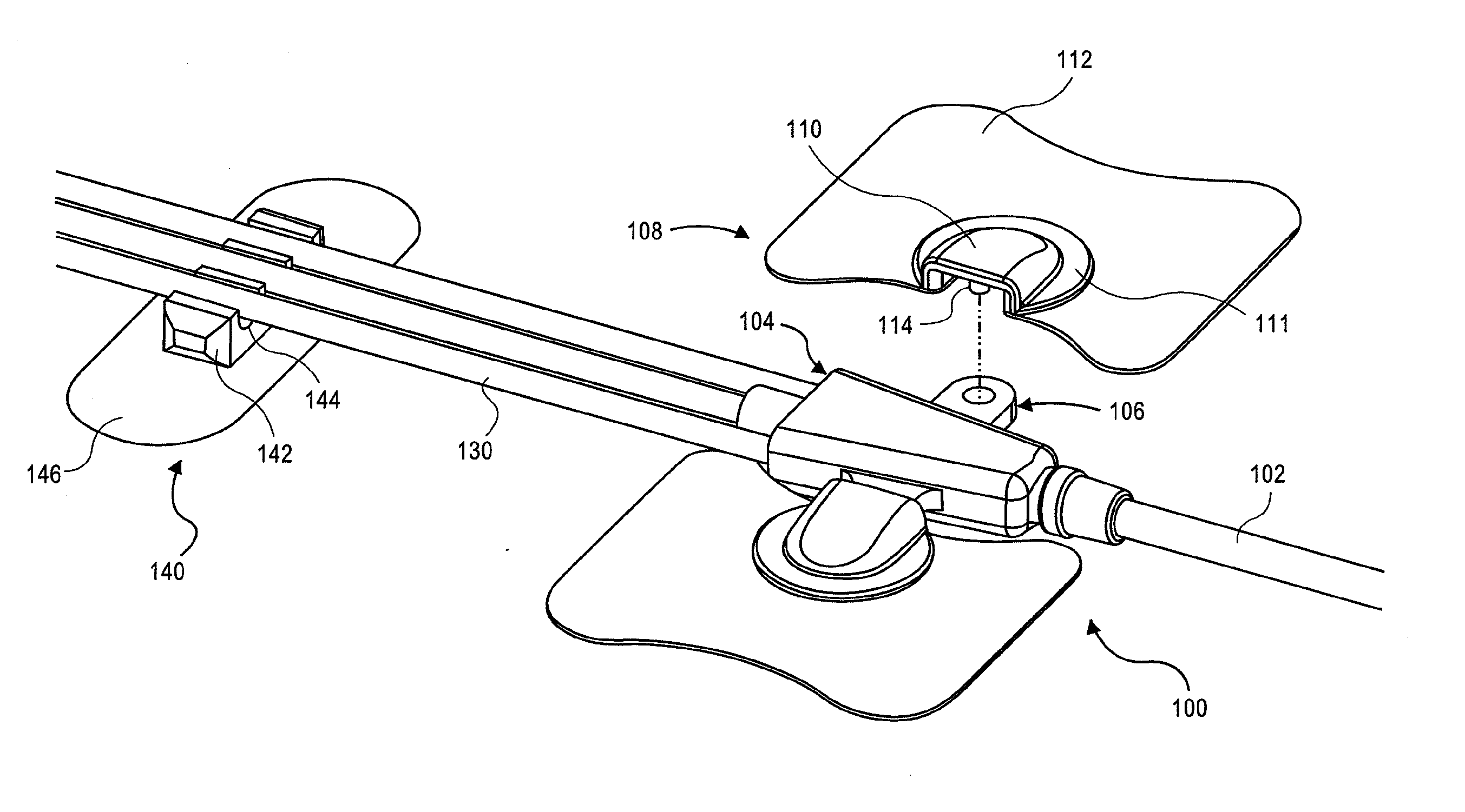 Catheter securement devices