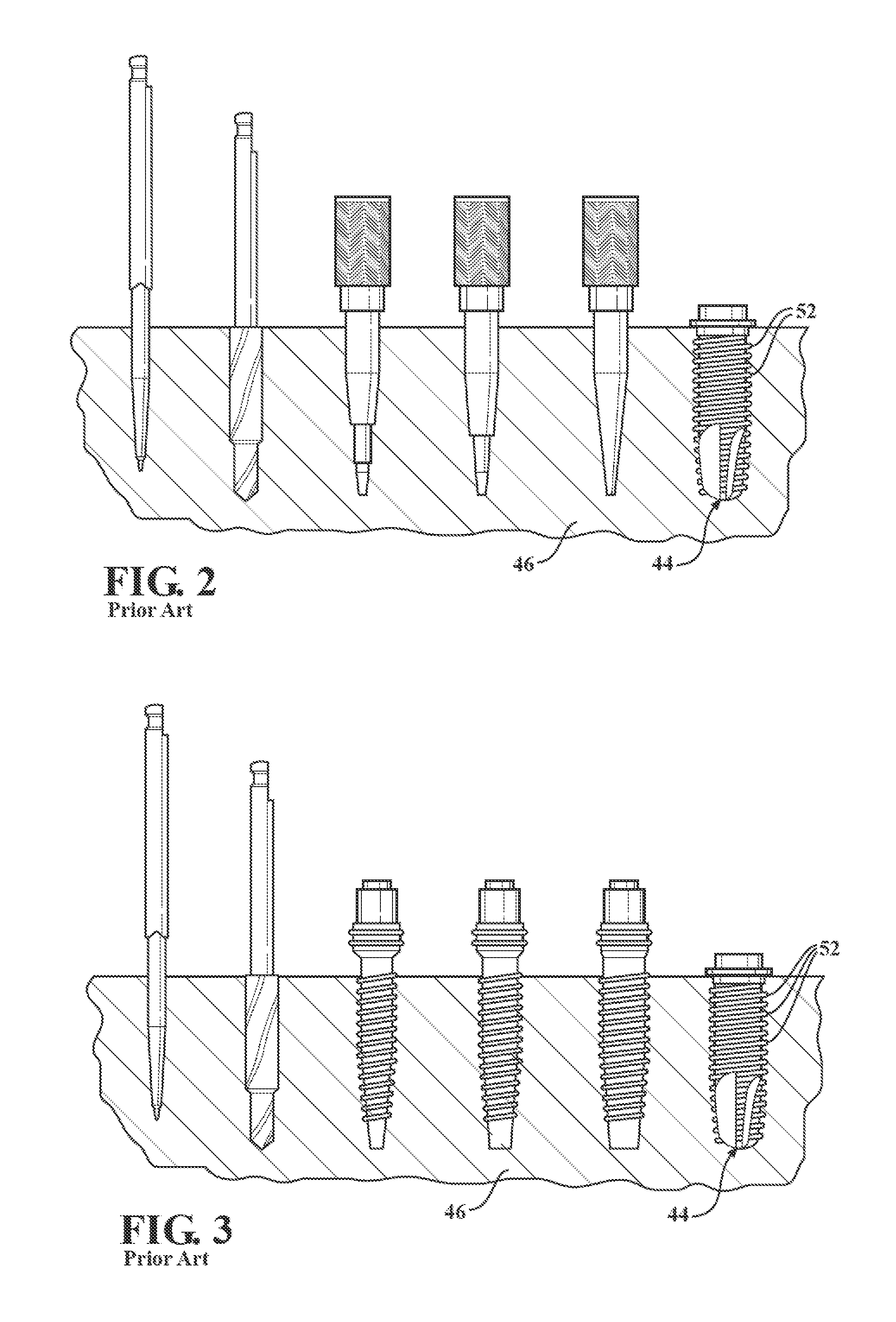 Fluted osteotome and surgical method for use