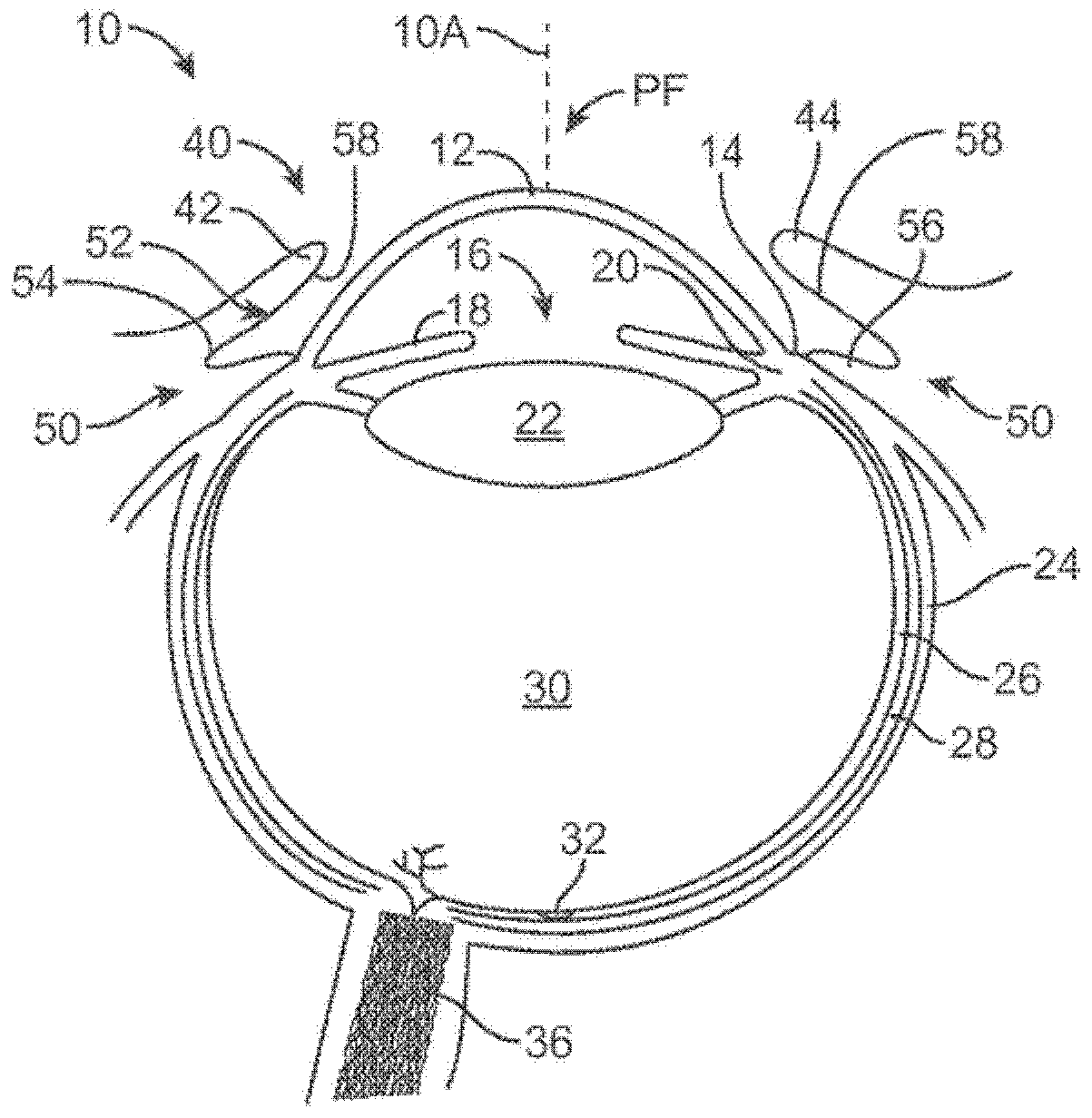 Ocular insert apparatus and methods