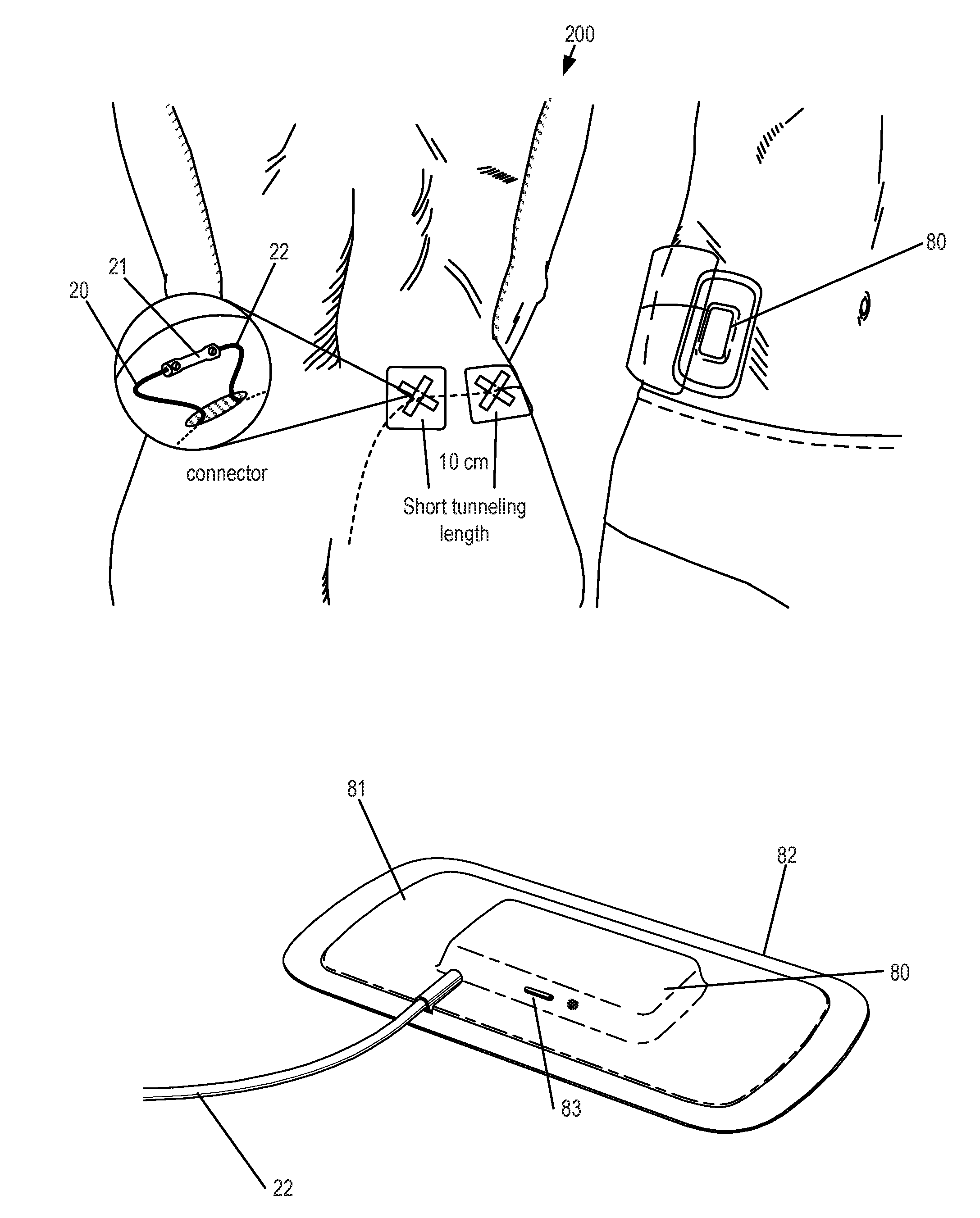 Antenna and methods of use for an implantable nerve stimulator