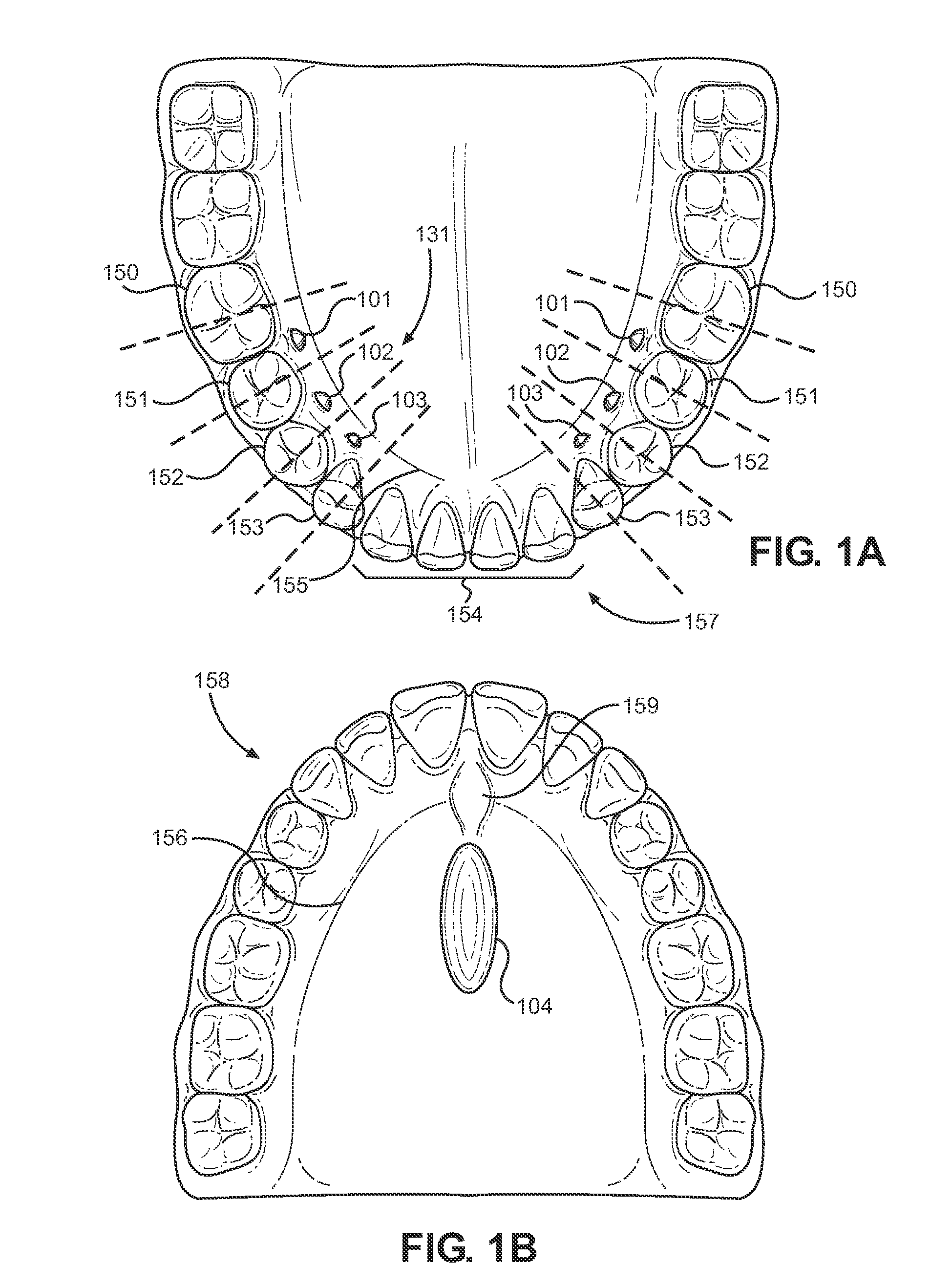 System and Method of Installing Dental Prostheses for Passively Influencing Tongue Position to Reduce Airway Obstruction