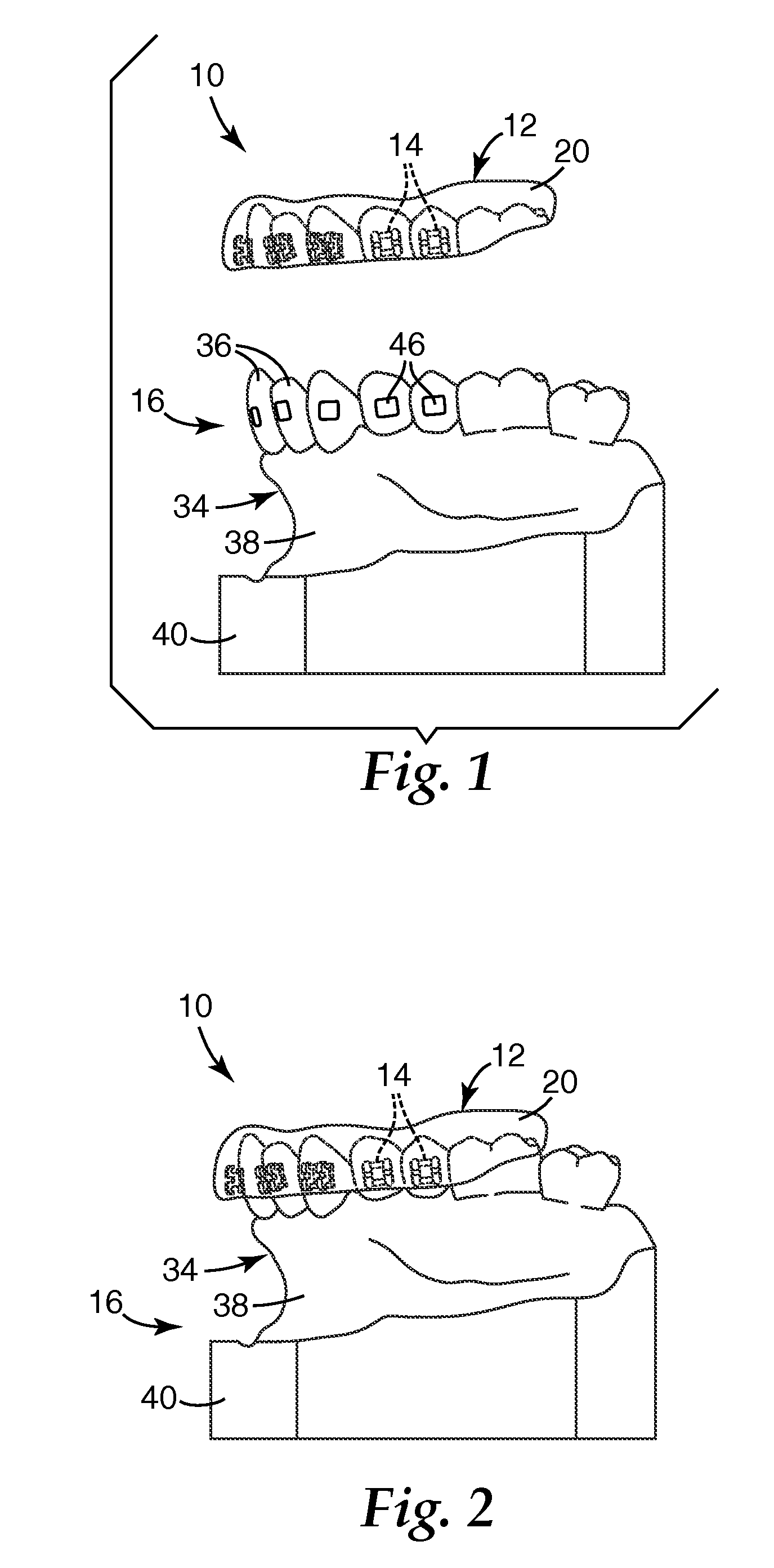 Orthodontic adhesive dispensing assembly