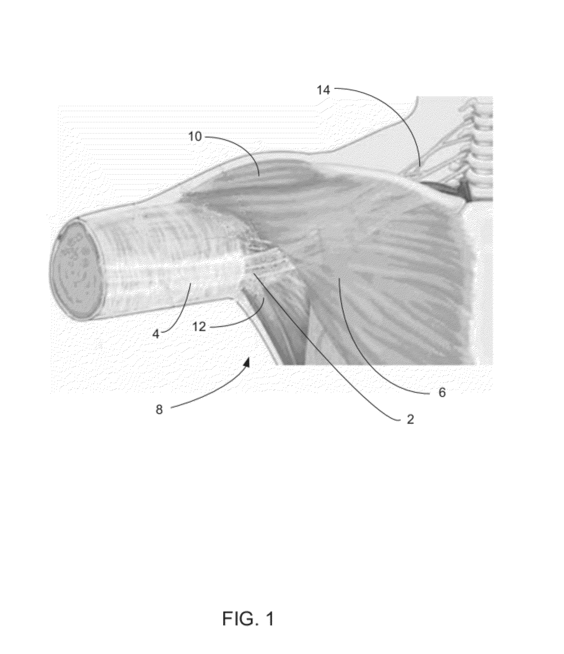 Apparatus and methods for controlling bleeding using externally applied pressure