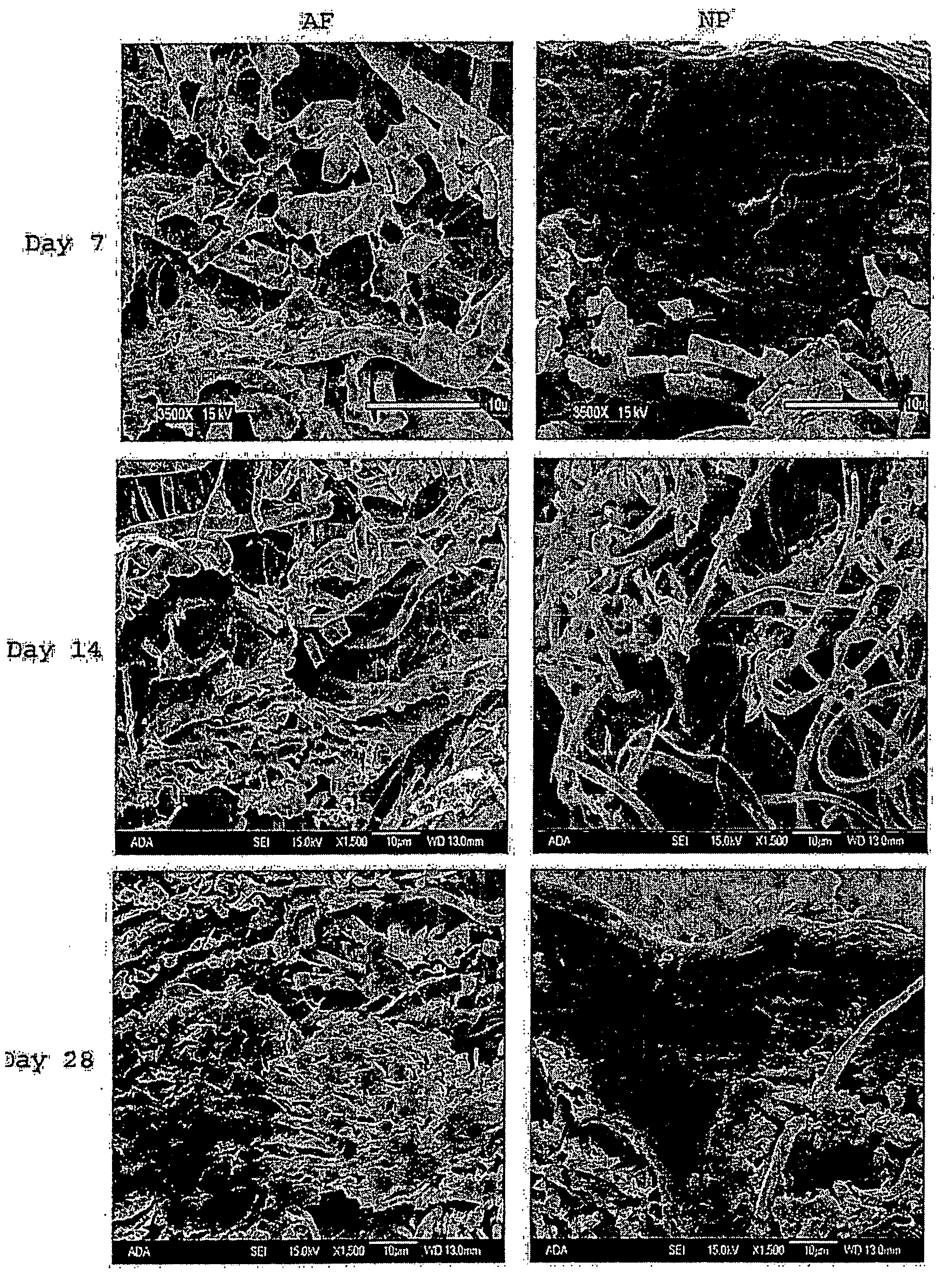 Cell-nanofiber composite and cell-nanofiber-hydrogel composite amalgam based engineered intervertebral disc