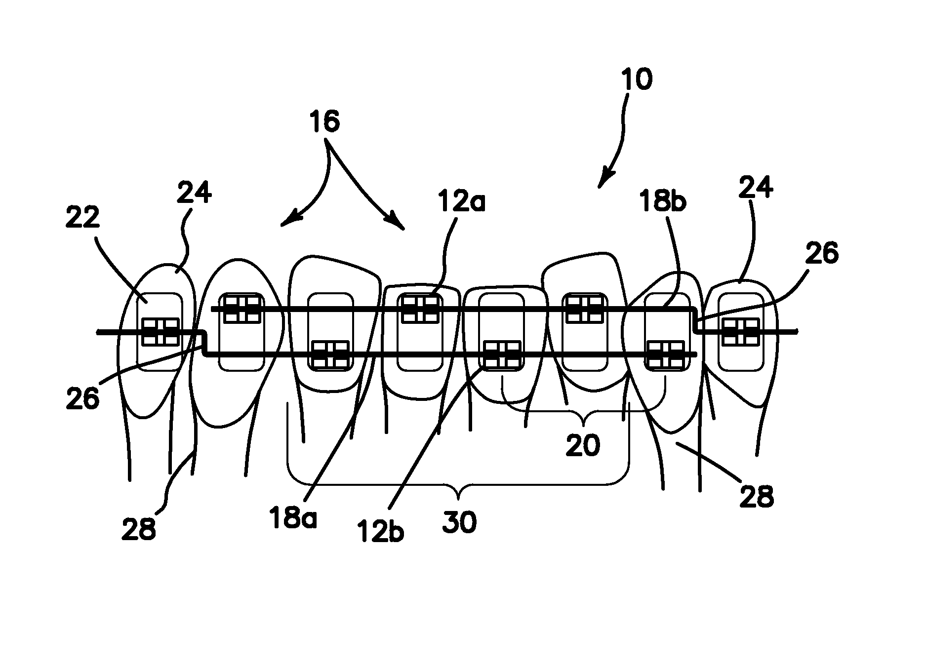 High/low bracket placements on lingual surfaces