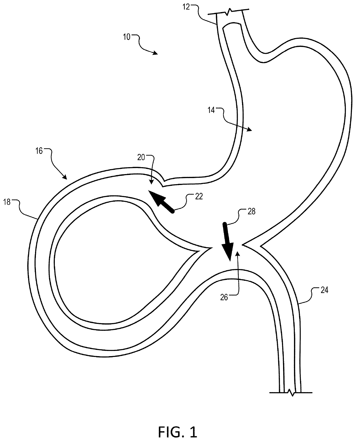 Methods and devices for gastricintestinal tract bypass