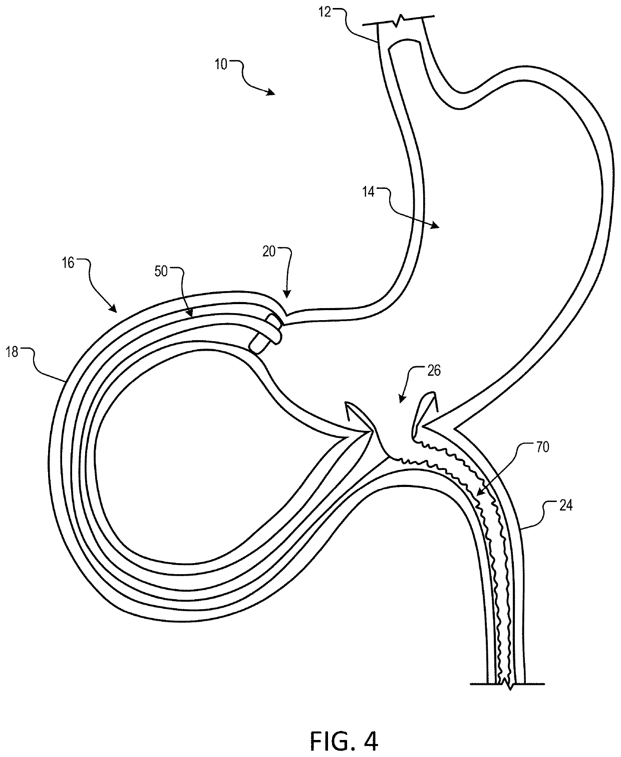 Methods and devices for gastricintestinal tract bypass