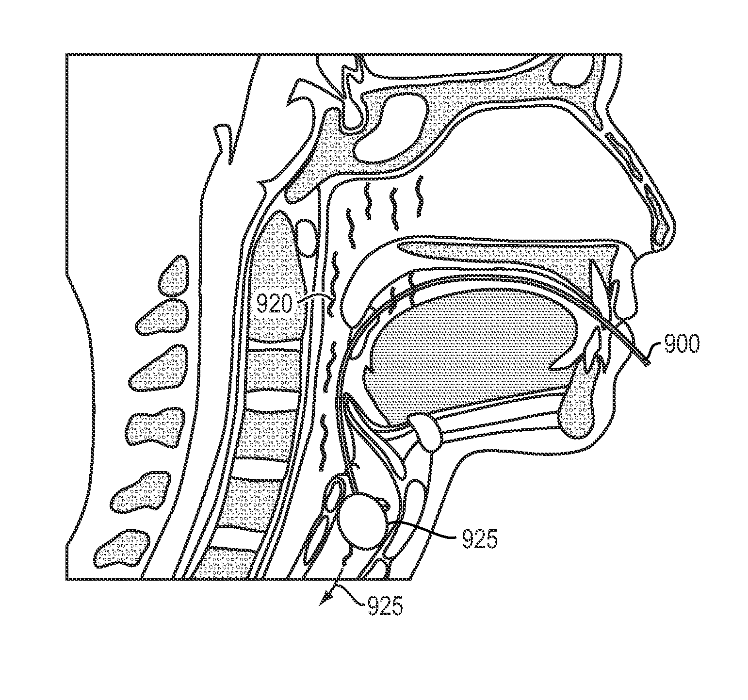 Apparatus and methods for treatment of obstructive sleep apnea utilizing cryolysis of adipose tissues