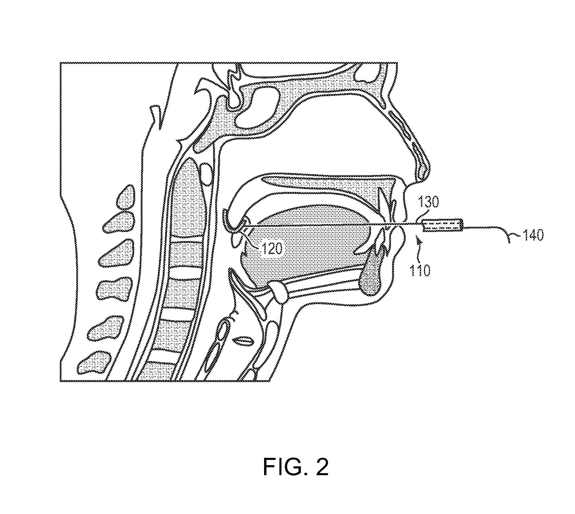 Apparatus and methods for treatment of obstructive sleep apnea utilizing cryolysis of adipose tissues