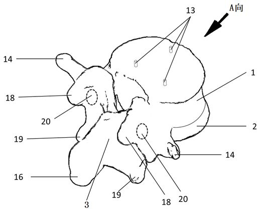 High-simulation customized combined artificial vertebra