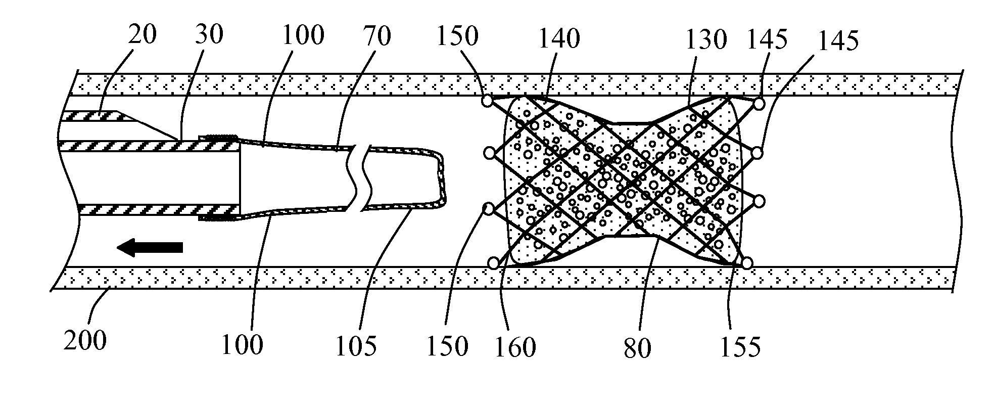 Systems and devices for intralumenal implantation