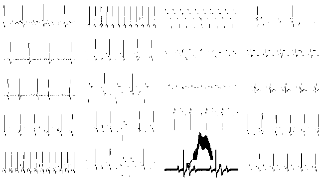 Deep convolutional neural network based fine grain electrocardiogram signal classification method fusing with online decisions