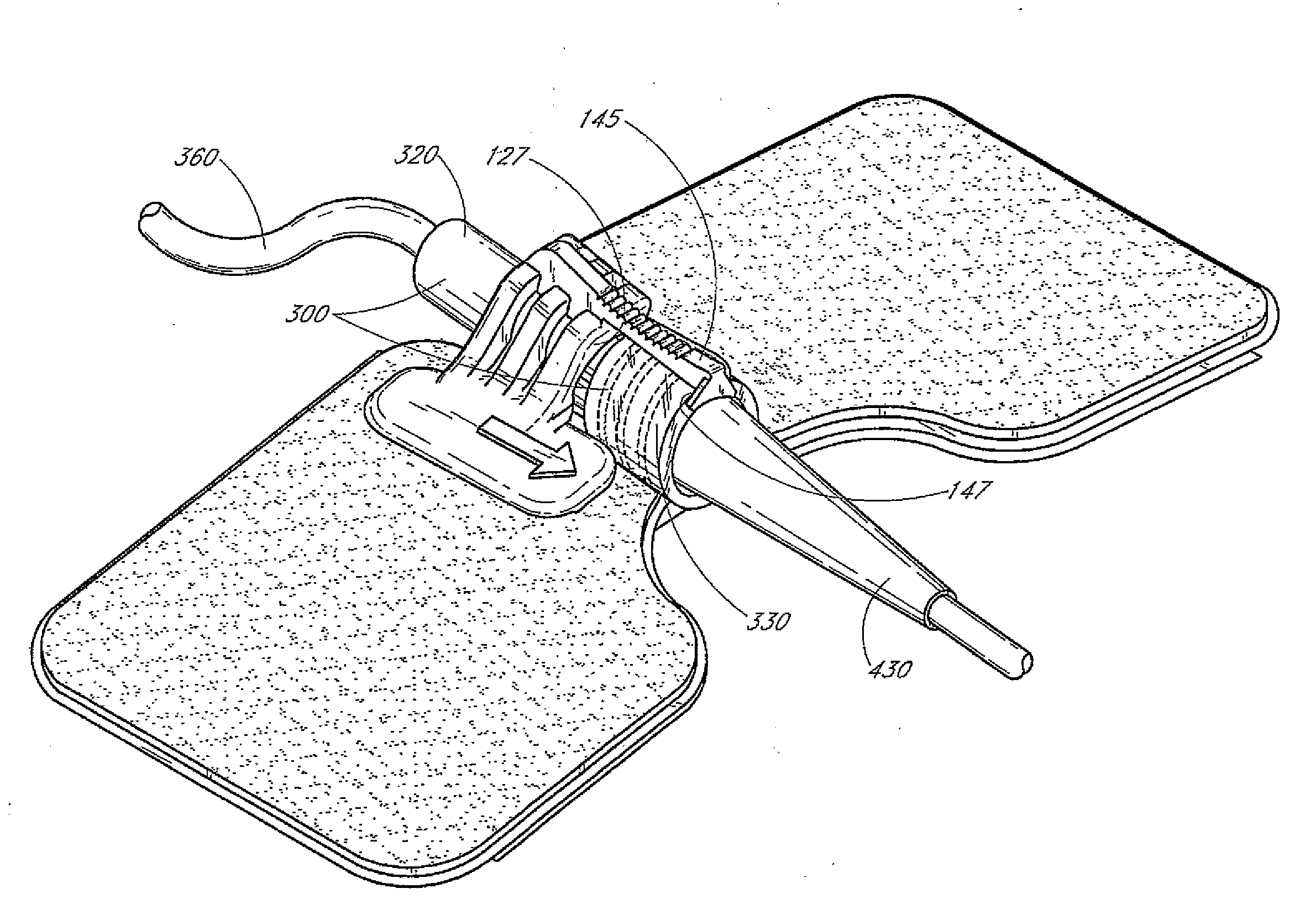 Catheter securement device