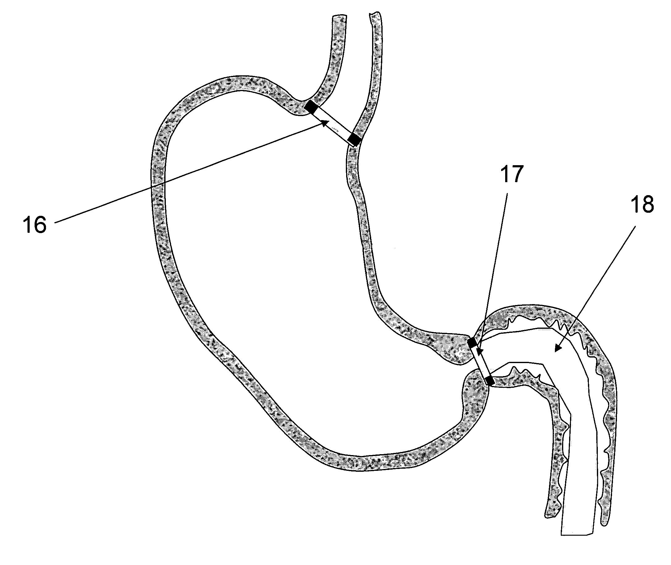 Method and apparatus for anchoring implants