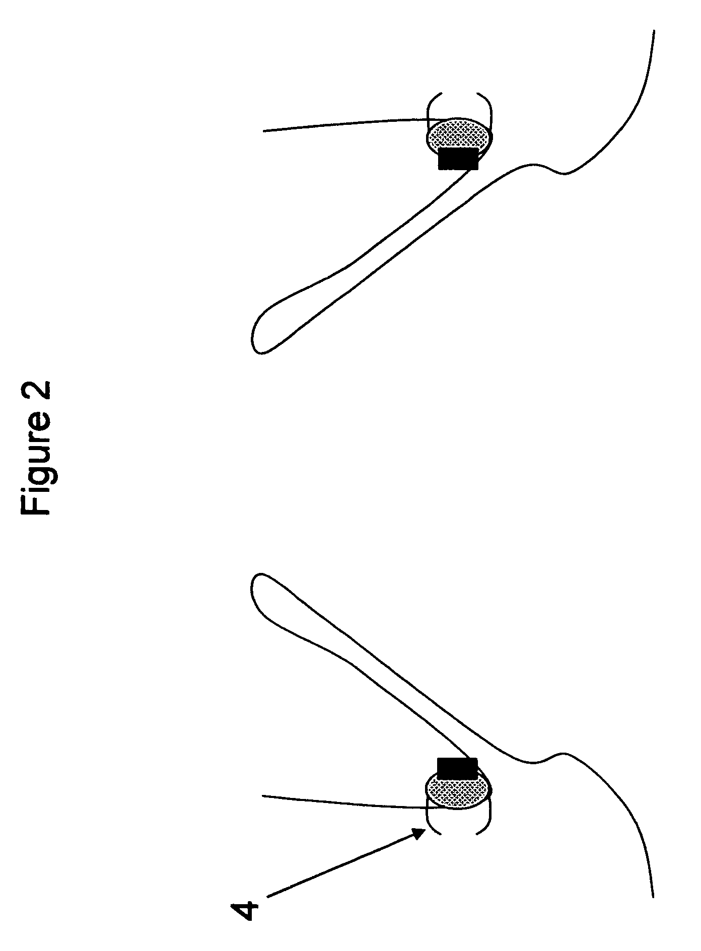 Method and apparatus for anchoring implants