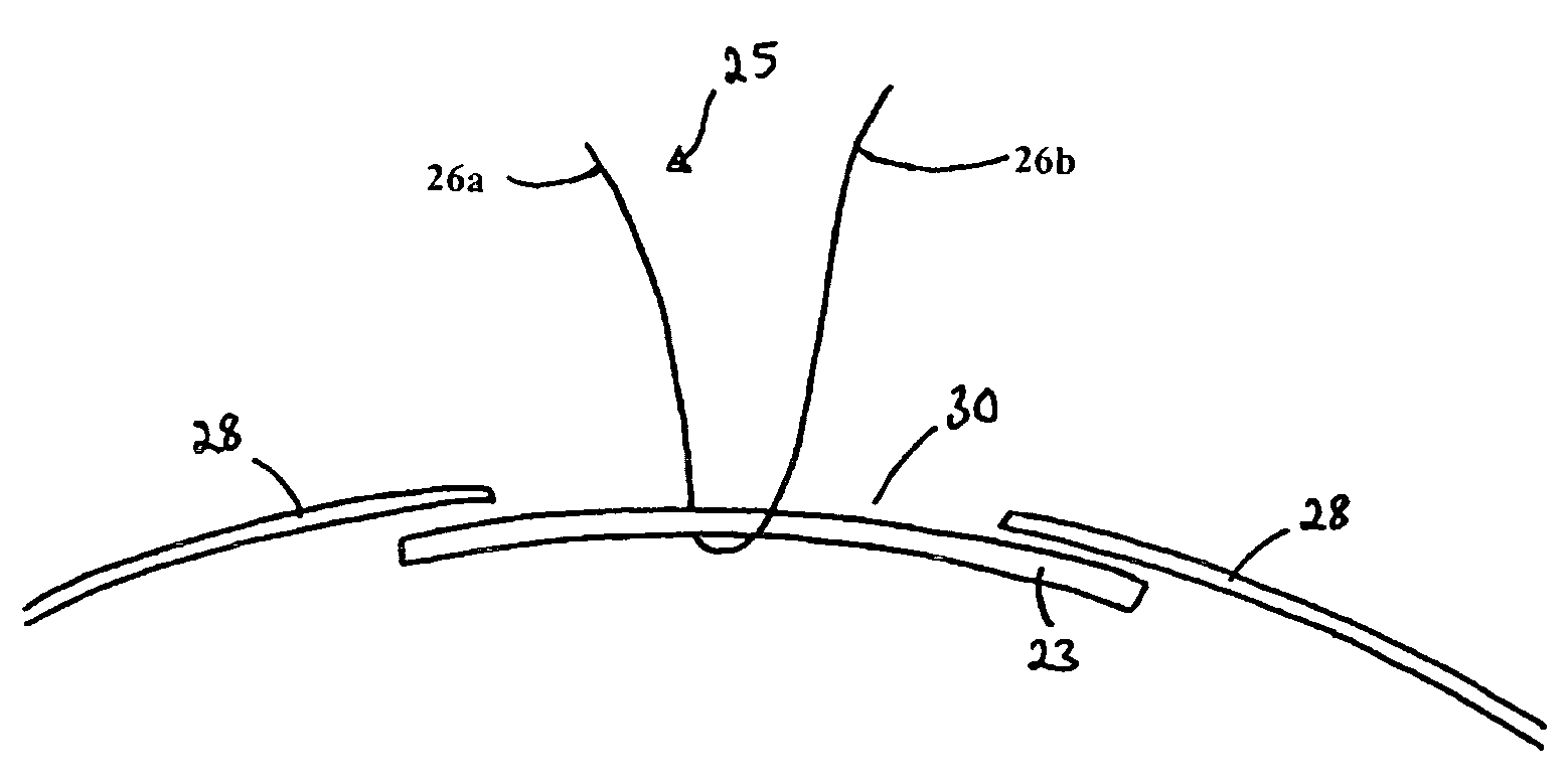 Device for use in eye surgery