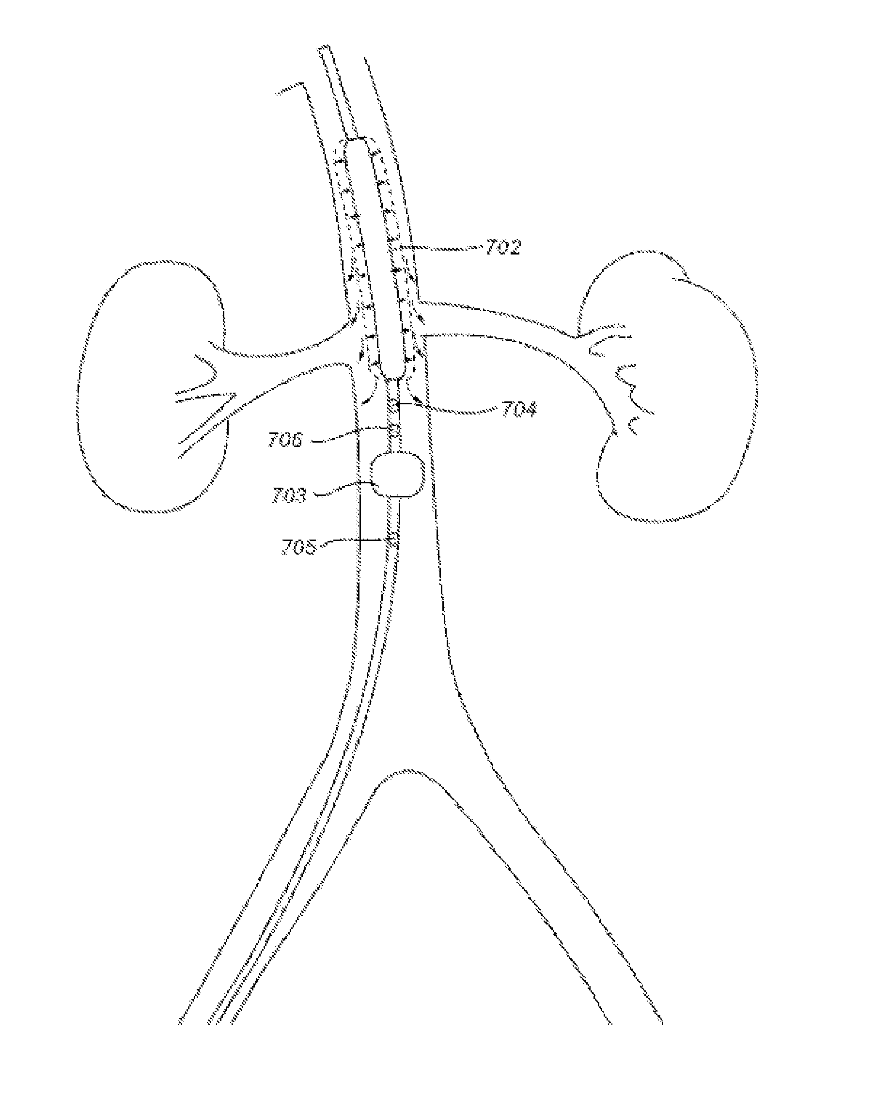 Devices and methods for treating acute kidney injury