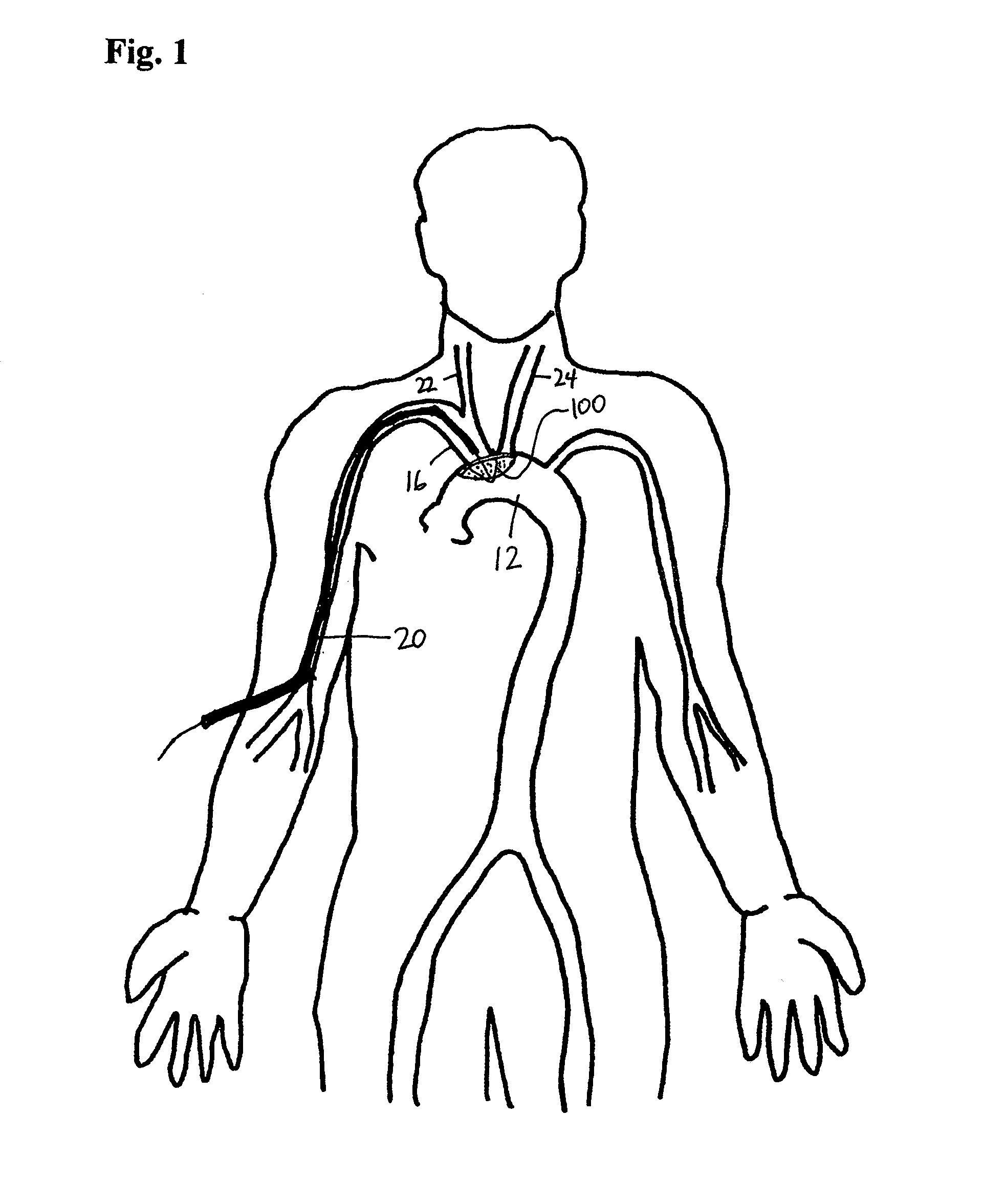 Method of deflecting emboli from the cerebral circulation