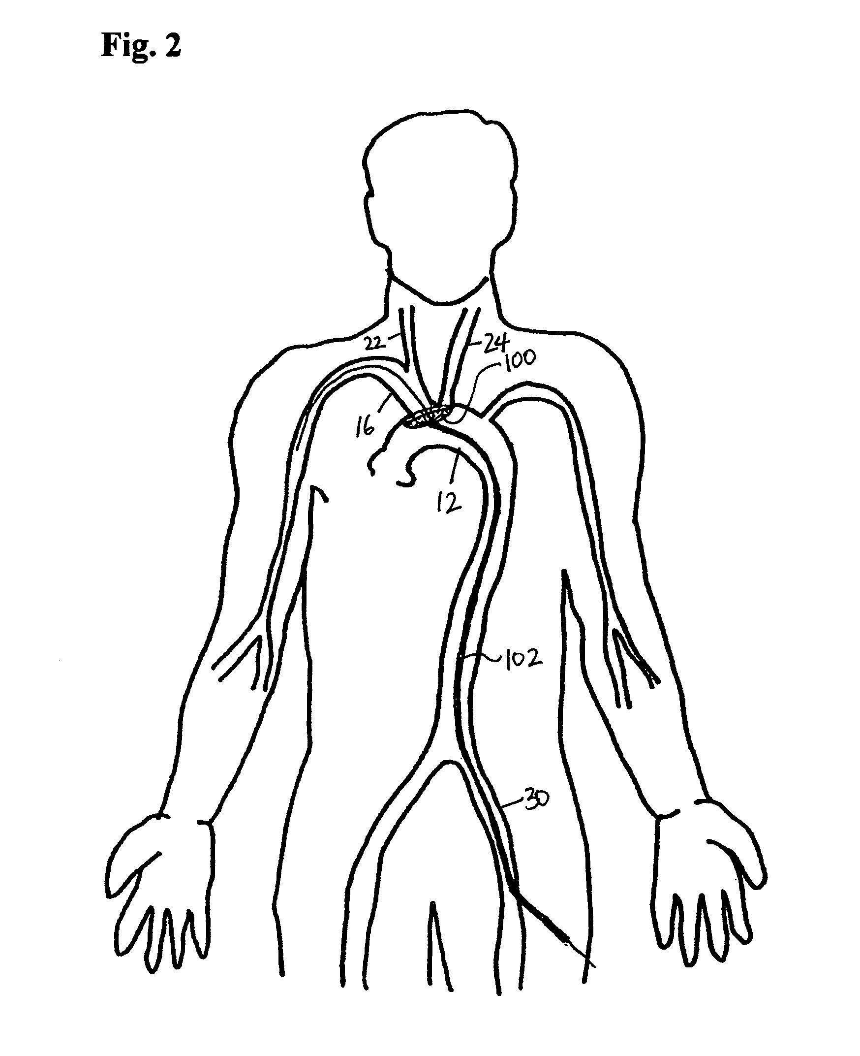 Method of deflecting emboli from the cerebral circulation