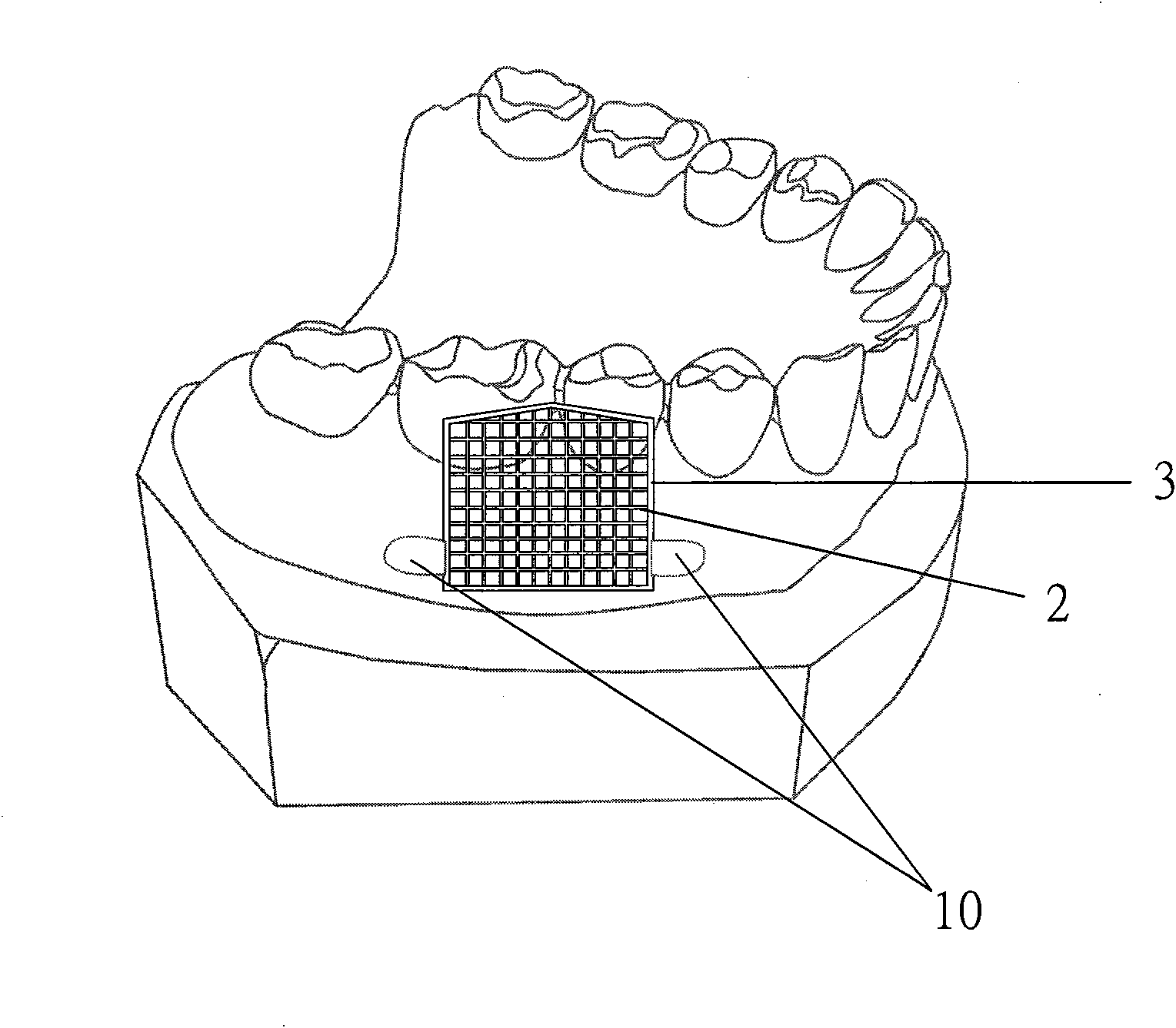 Interdental space direct measurement and oral cavity orthodontics micro-implant positioning implantation method