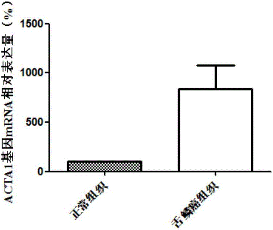 Use of ACTA1 as diagnosis and treatment marker of tongue squamous cell carcinoma