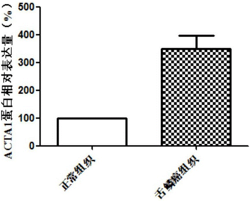 Use of ACTA1 as diagnosis and treatment marker of tongue squamous cell carcinoma