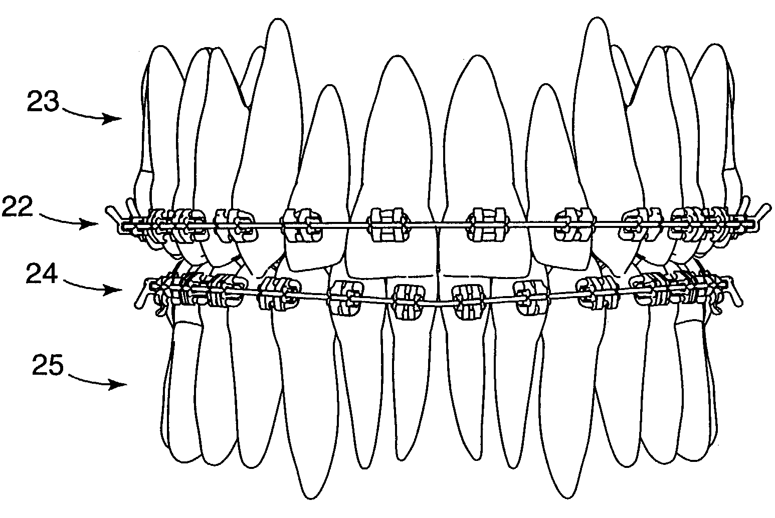 Orthodontic brace with self-releasing appliances