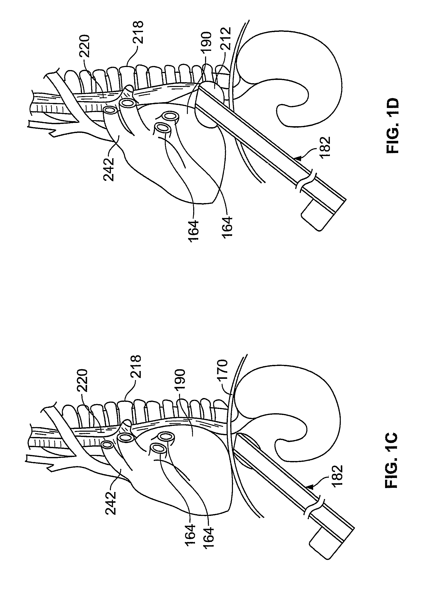 Diaphragm entry for posterior surgical access